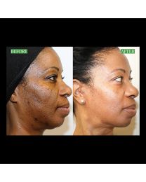 VI Peel Precision Plus B&A