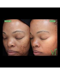 VI Peel B&A