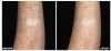 Fraxel B&A1