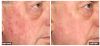 Fraxel B&A3