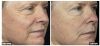 Fraxel B&A4
