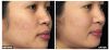 Fraxel B&A5