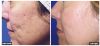 Fraxel B&A6