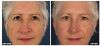 Fraxel B&A7