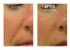 HydraFacial B&A