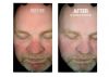 HydraFacial B&A
