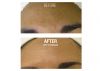 HydraFacial B&A