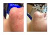 HydraFacial B&A