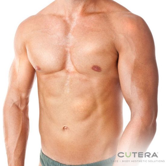 Laser Hair Removal for Men