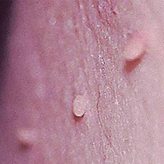 Skin Tag Excision (2 Options)