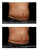 SculpSure®  Before & After 1
