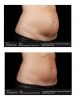 SculpSure®  Before & After 4