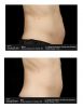 SculpSure®  Before & After