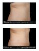 SculpSure®  Before & After 2