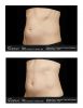 SculpSure®  Before & After 3