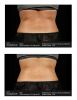 SculpSure®  Before & After 5