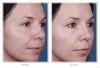 Obagi Blue Peel before and after