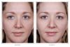 Obagi Blue Peel before and after