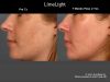 Limelight IPL before and after