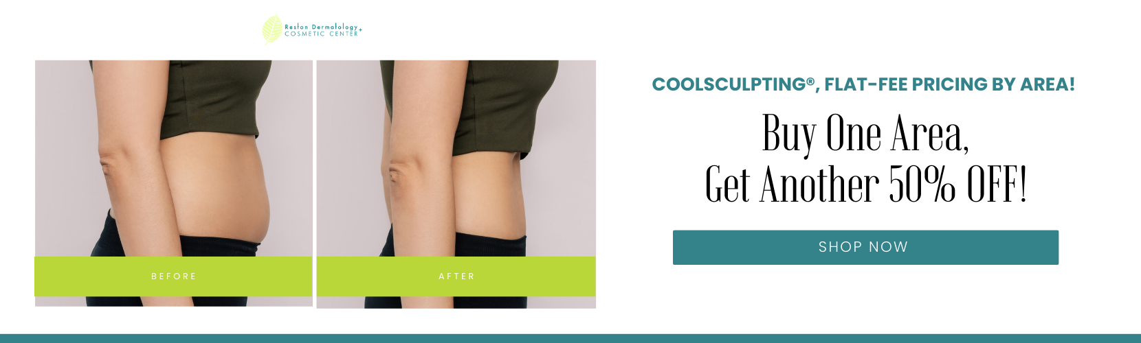 CoolSculpting®, Flat-Fee Pricing by Area!  Buy One Area, Get Another 50% OFF!