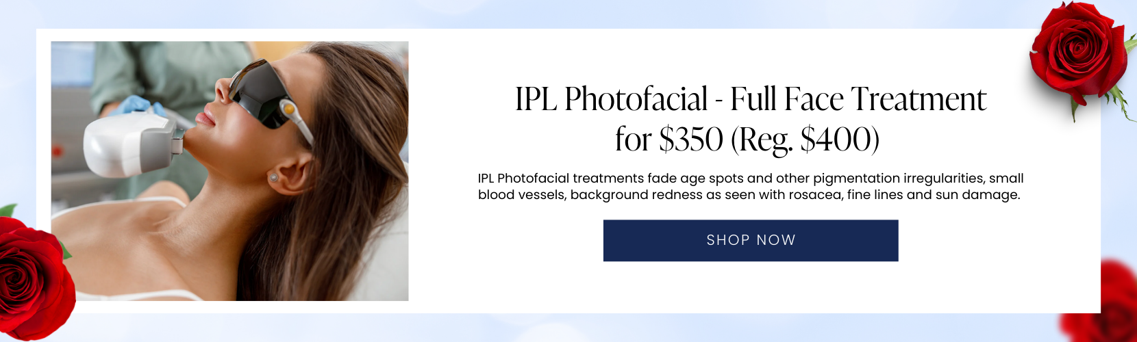 IPL Photofacial - Full Face Treatment for $350 (Reg. $400) 