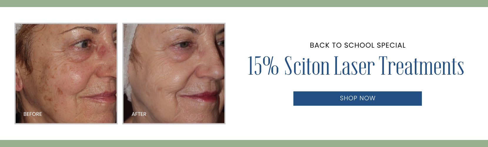 15% Sciton Treatments