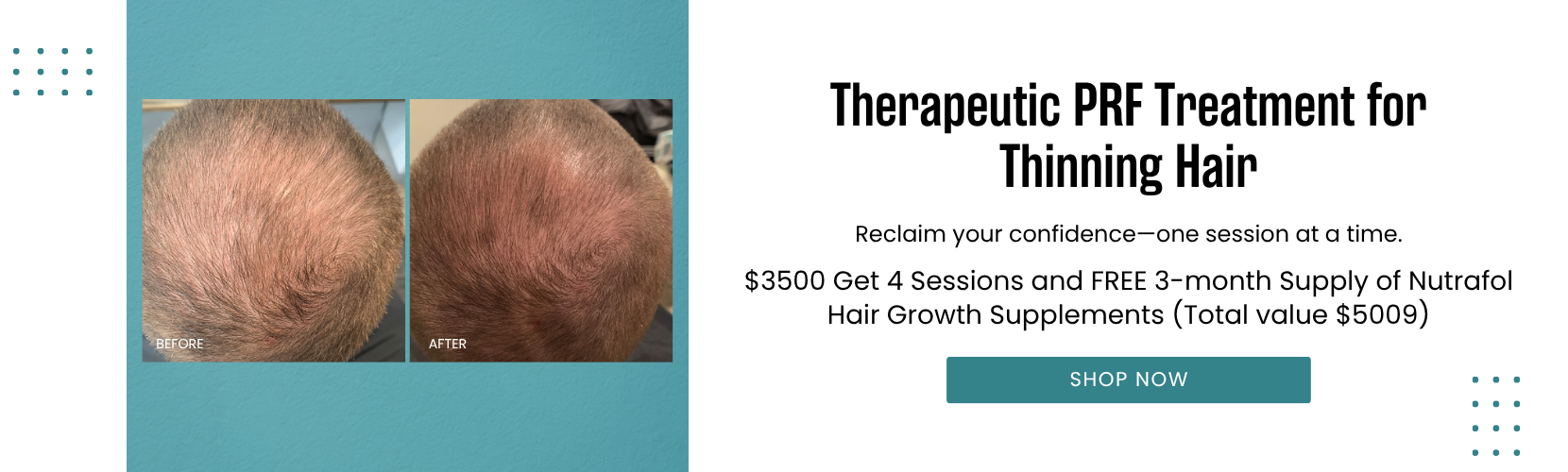 Therapeutic PRF Treatment for Thinning Hair $3500