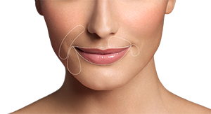 Restylane