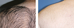 laser hair removal before and after