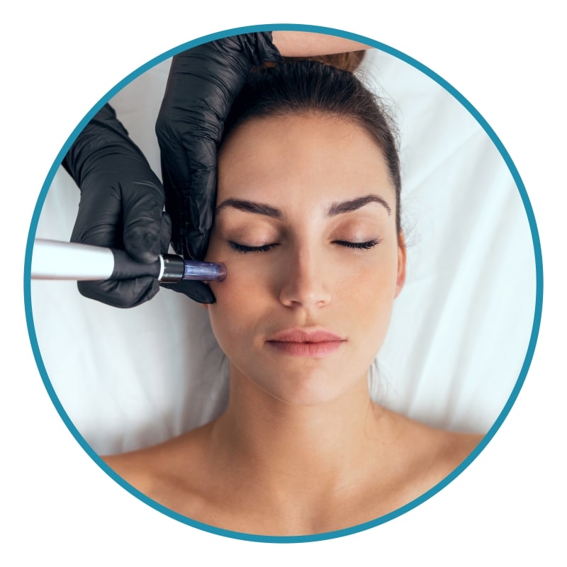 Microneedling